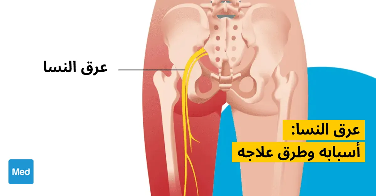 عرق النسا: أسبابه وطرق علاجه
